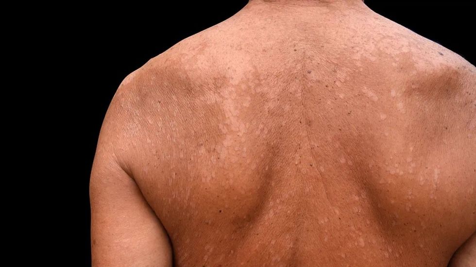 tinea versicolor body1