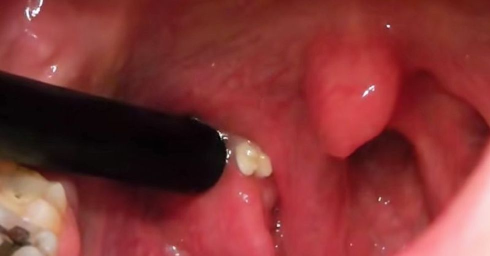 tonsil stones FI