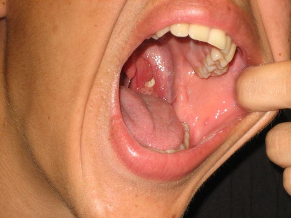 Tonsil stones