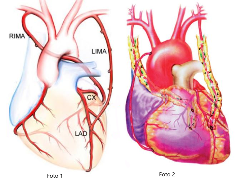Totalna revaskularizaci a na srce ZMC AL