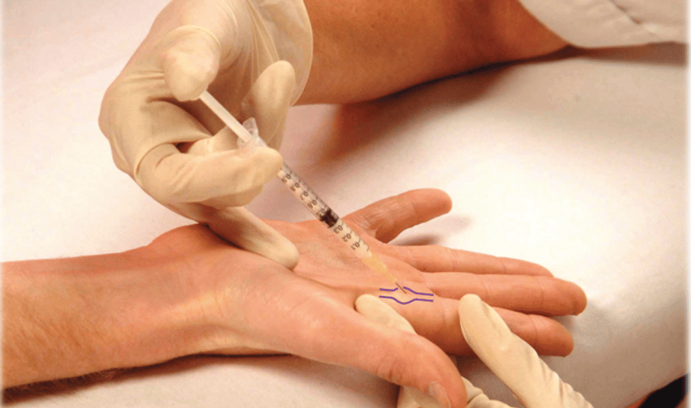 Trigger finger injection procedure