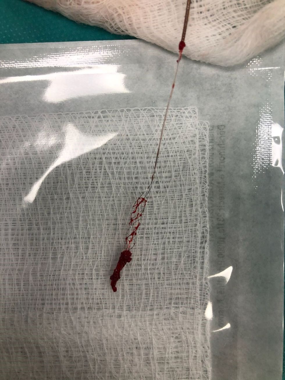 Trombi i nxjerre ne pjesen distale te stent retrivier