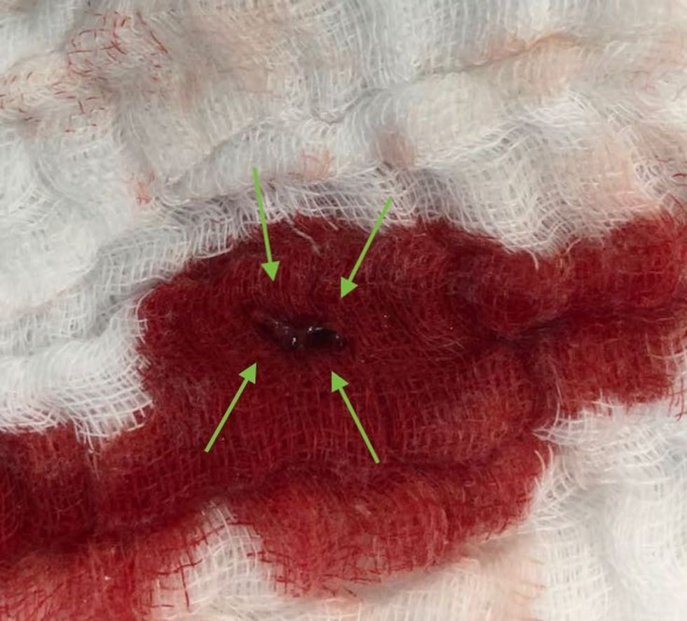 Trombit i nxjerre me trombektomi mekanike