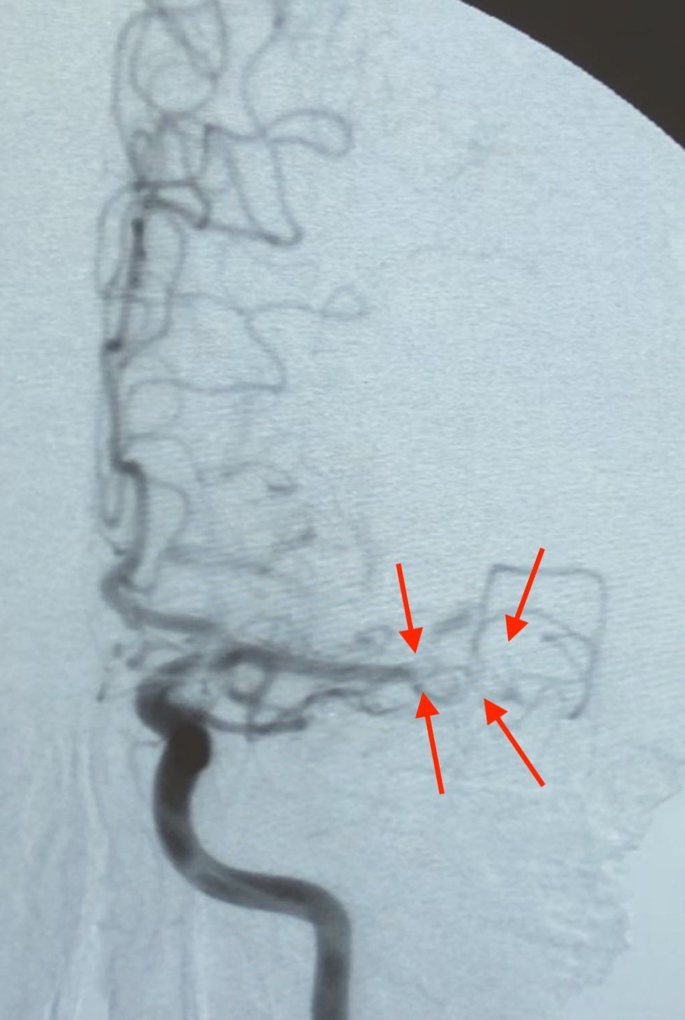 Trombozim i pjesës distale të ACM majtas
