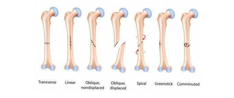 types of bone fractures 1