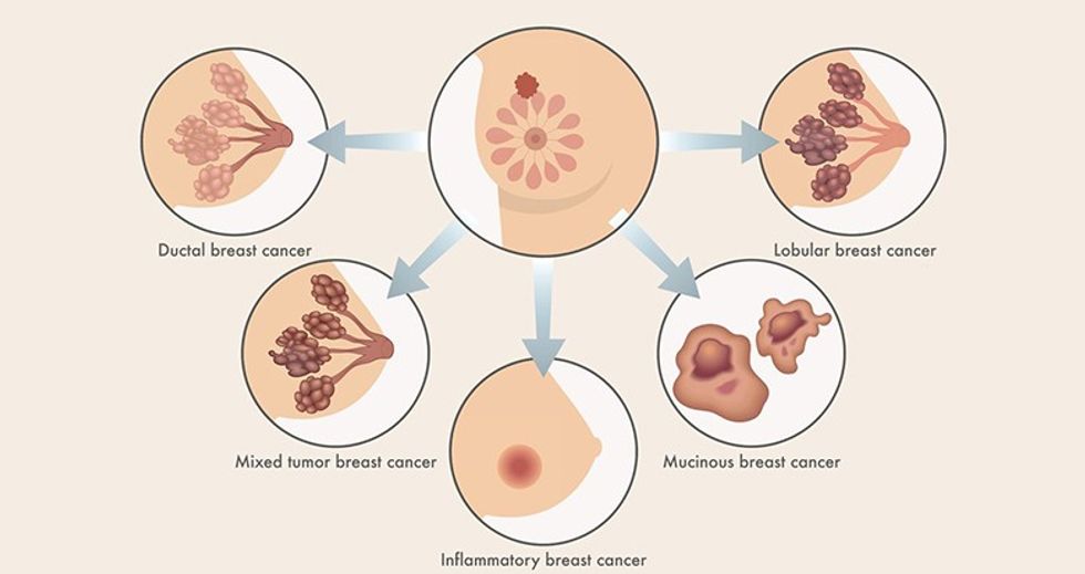 types of breast cancer guide 1