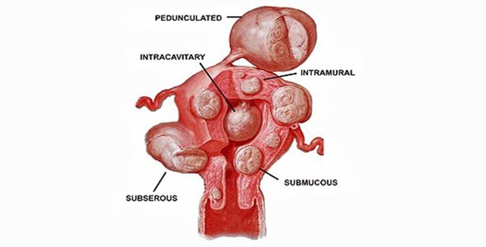 TypesofMyoma