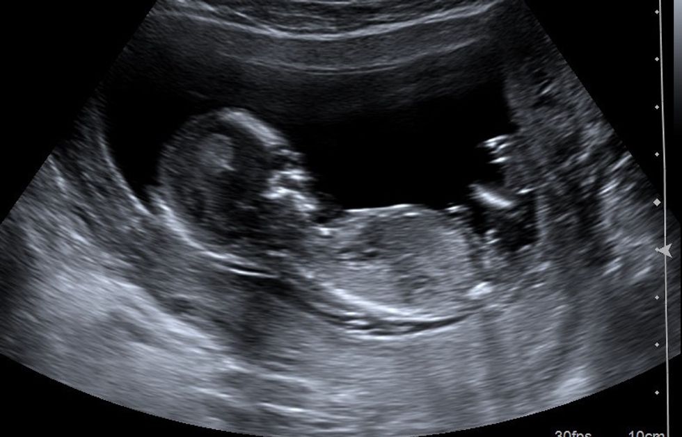 ultrasound 3 at 13 weeks