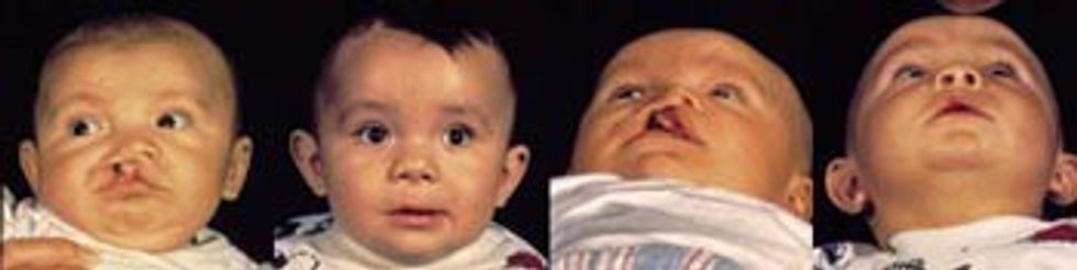 uni cleft lip and palate2