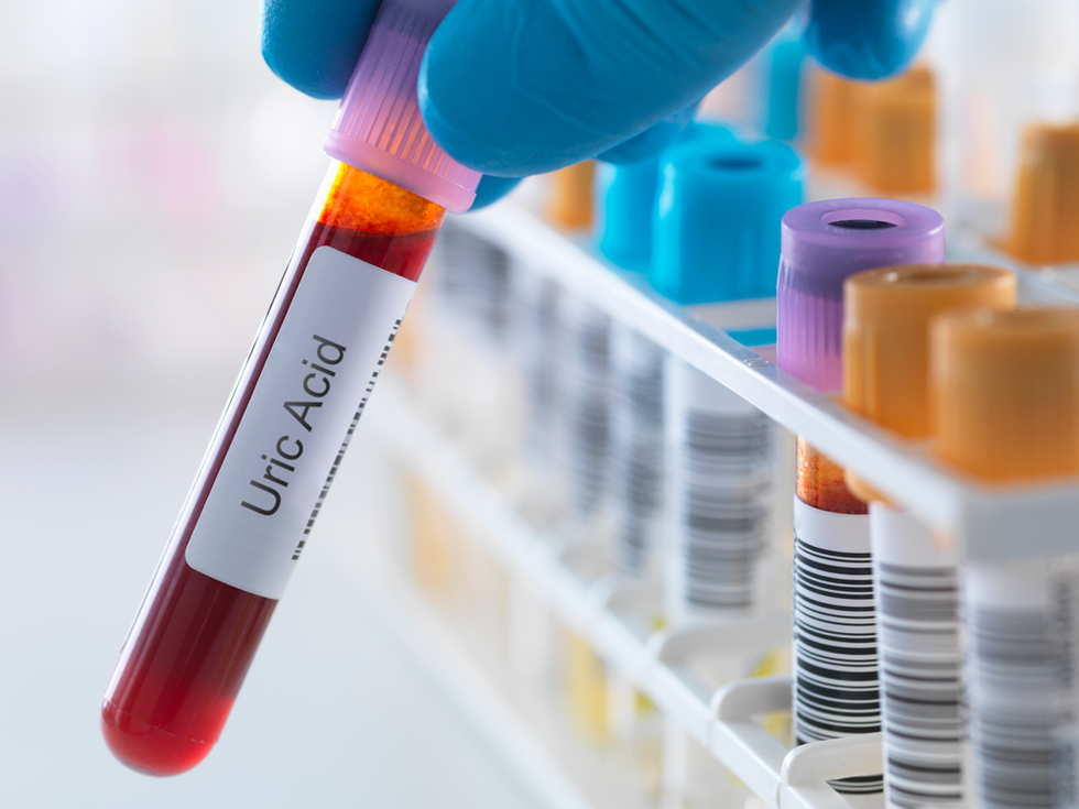 uricacidg482186651 1354538