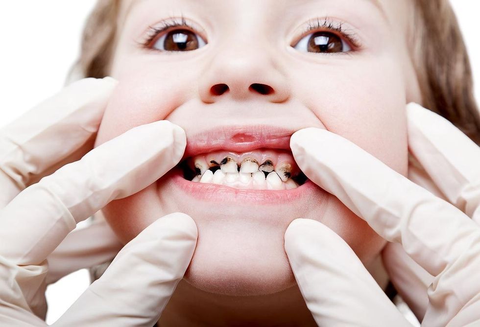 vaiku dantu eduonies gydymas 01