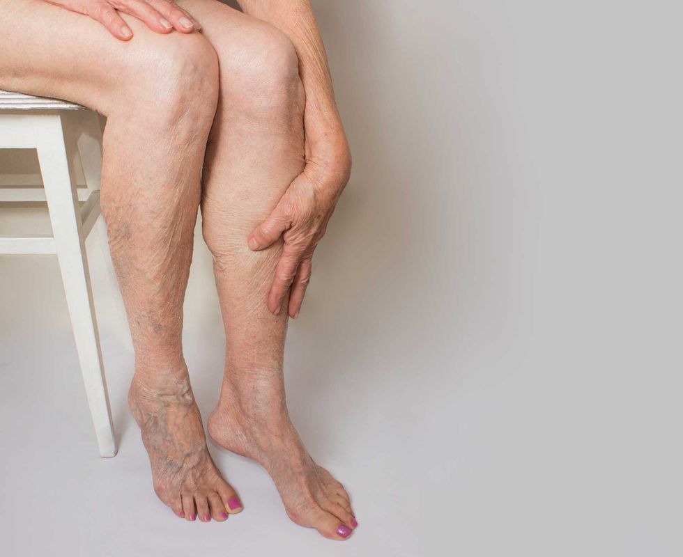 Varicose veins on a female legs 867848786