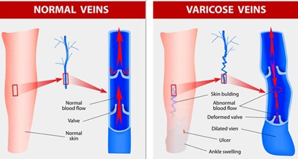 Varicose