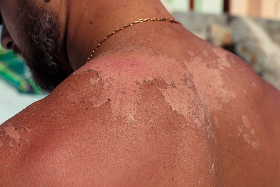 very bad sunburn showing the peeling blistered skin of a mans back