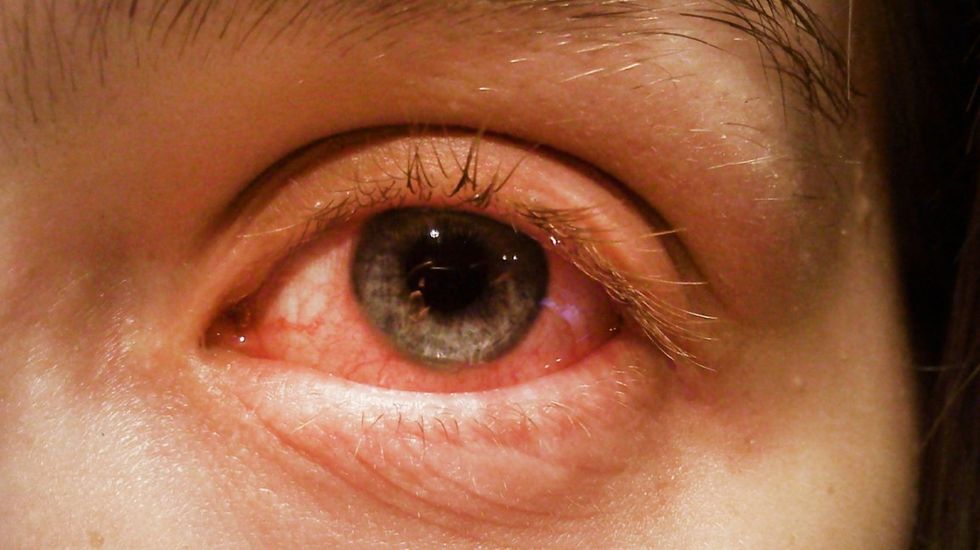 Viral Conjunctivitis gallery Slide1