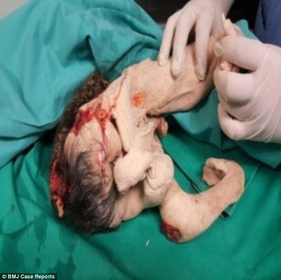 Vuante nga dhimbjet e barkut i nxjerrin binjakun identik qe nuk kishte lindur kurre foto 2