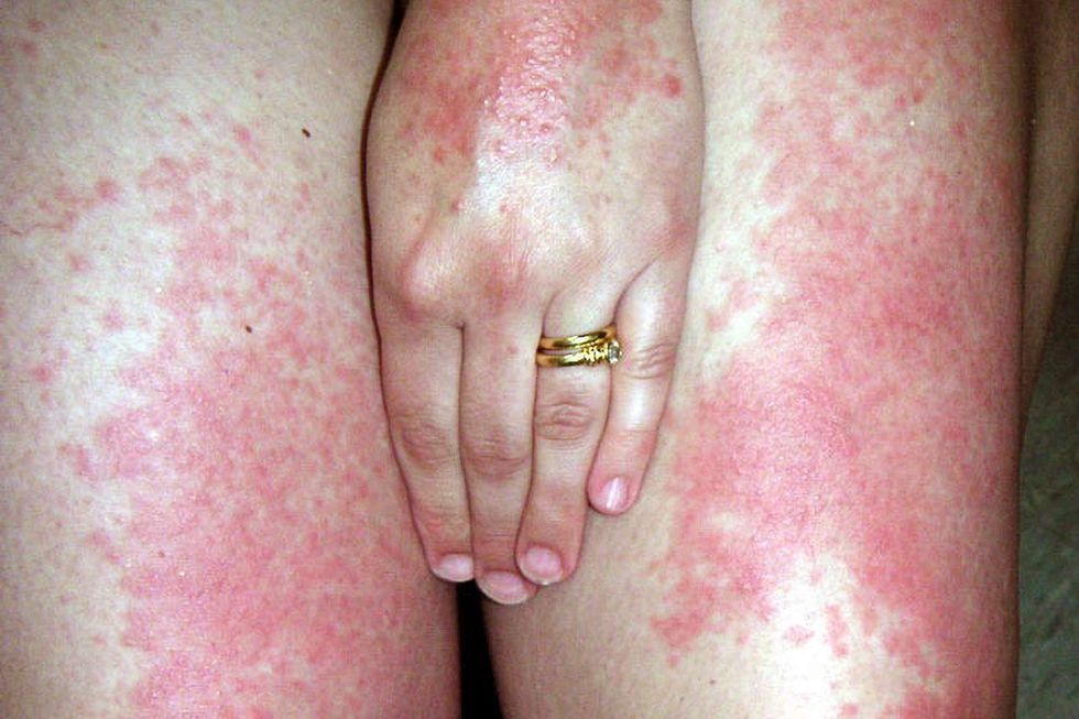 VWH DermNet SunRash 01 070b0a6c4c344721ae4c68fffcd6aa79 1