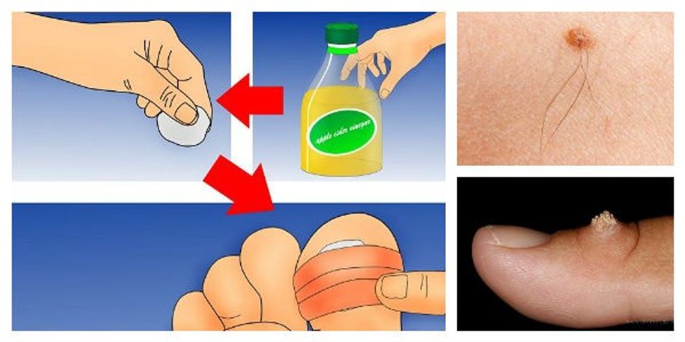 wart-mole-apple-cider-vinegar