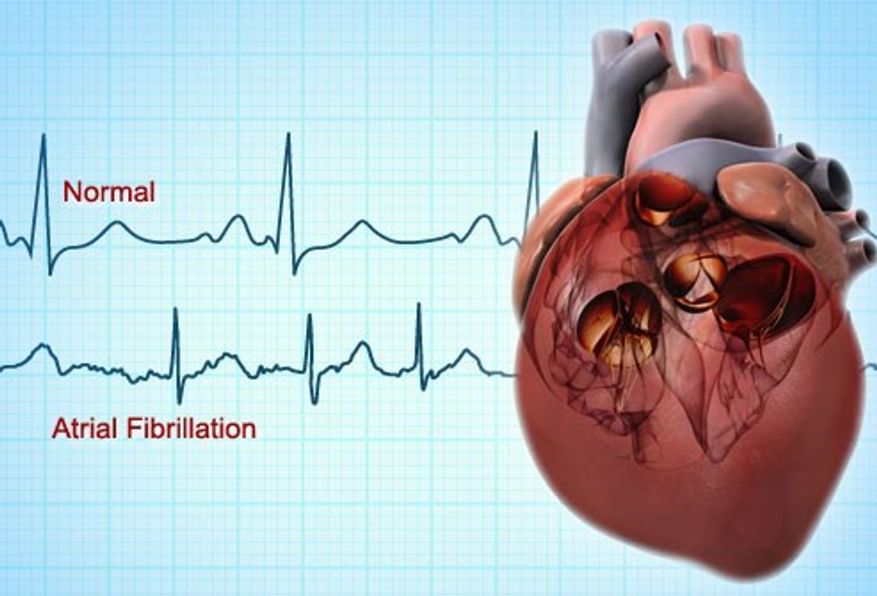 webmd rf photo of atrial fibrillation