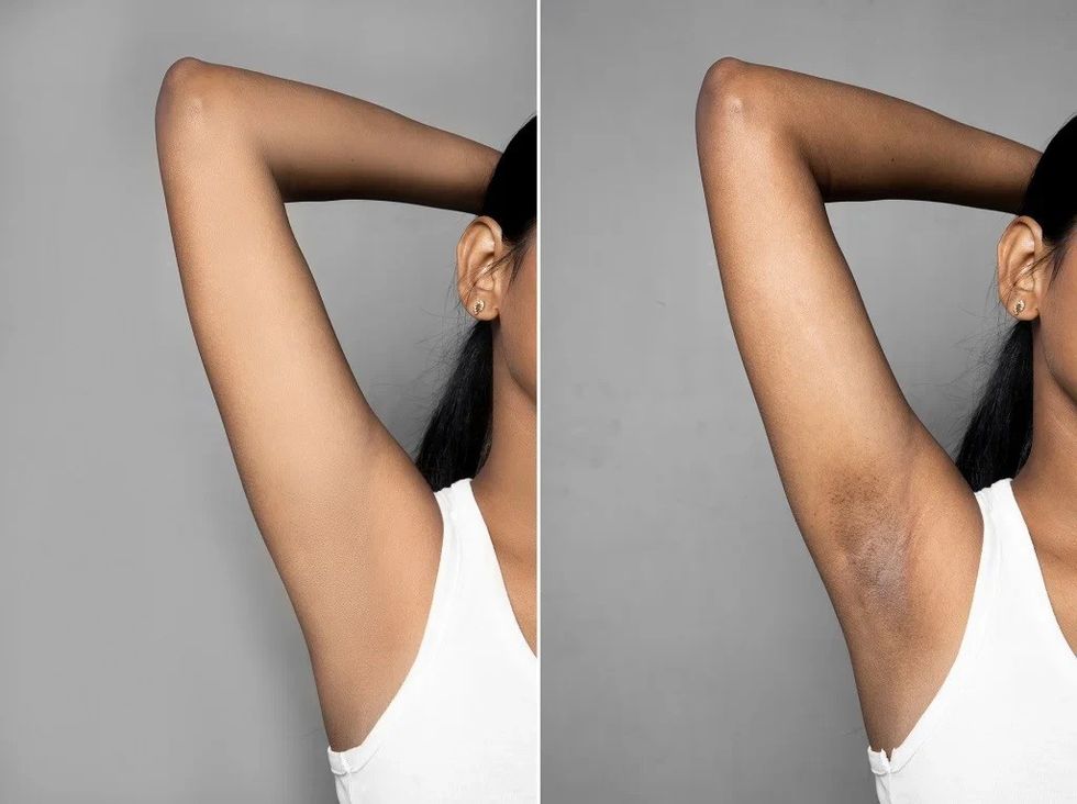 What Causes Dark Underarms Here Are Easy And Effect