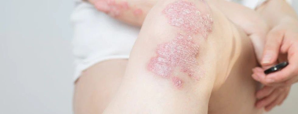 what is psoriasis 1