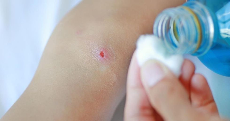 Wolf Spider Bite Treatment