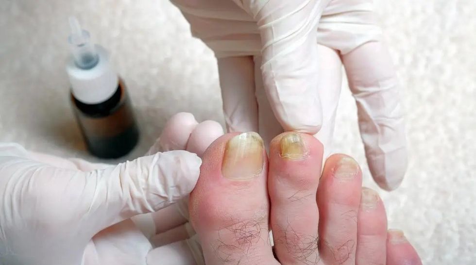 yellow toenails being inspected b