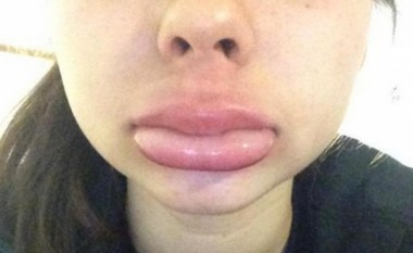 Adoleshentët i fryjnë buzët me metoda të dhimbshme, ja “rezultatet”
