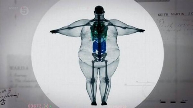 E pa besueshme – Ja si qëndron skeleti i njeriut që peshon 407 kilogram