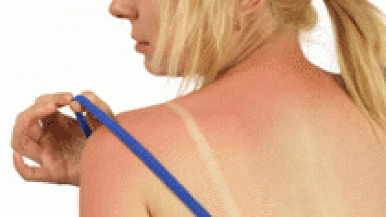 Si ta mbrojmë lëkurën nga veprimi i dëmshëm i rrezeve UV?