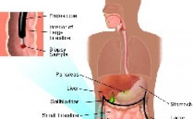 Trajtimi i sëmundjes Crohn