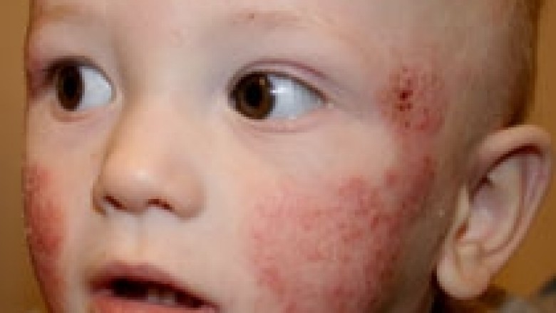 Kuroni sëmundjet e lëkurës te fëmijët