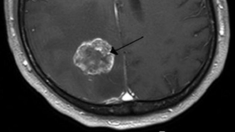 Hulumtuesit shënjestrojnë qelizat amë të kancerit në tumoret malinje të trurit