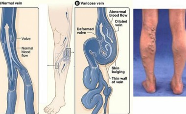 Nëse keni problem me vena të zgjeruara, në Anaderm bëhet shërimi i tyre