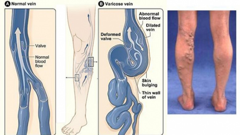Nëse keni problem me vena të zgjeruara, në Anaderm bëhet shërimi i tyre
