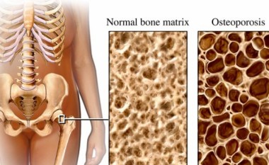 Këshillat e “New 20” për Osteoporozën