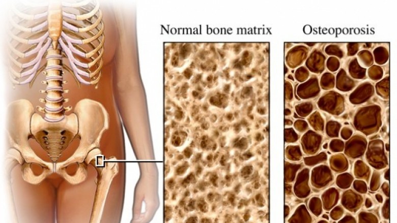 Osteoporoza e përcaktuar nga gjenet?