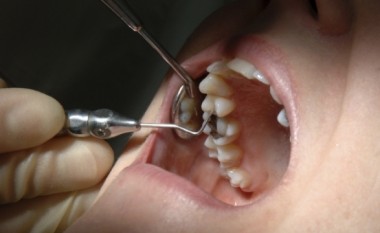 Sëmundja e mishit të dhëmbëve mund të jetë shenjë e hershme e Alzheimerit
