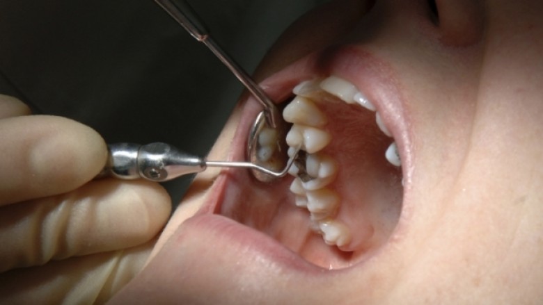 Sëmundja e mishit të dhëmbëve mund të jetë shenjë e hershme e Alzheimerit