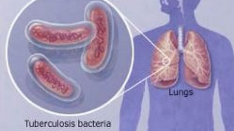 Shqetësuese, sëmundja e TBC-së në Kosovë
