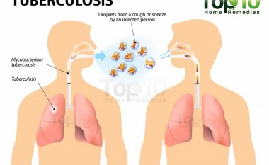 Numri i të prekurve nga tuberkuloza në Maqedoni vazhdimisht bie