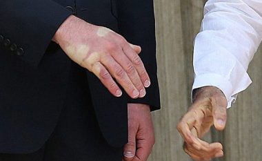 Shtrëngimi prej lideri që la shenja në dorën e Princit (Foto)
