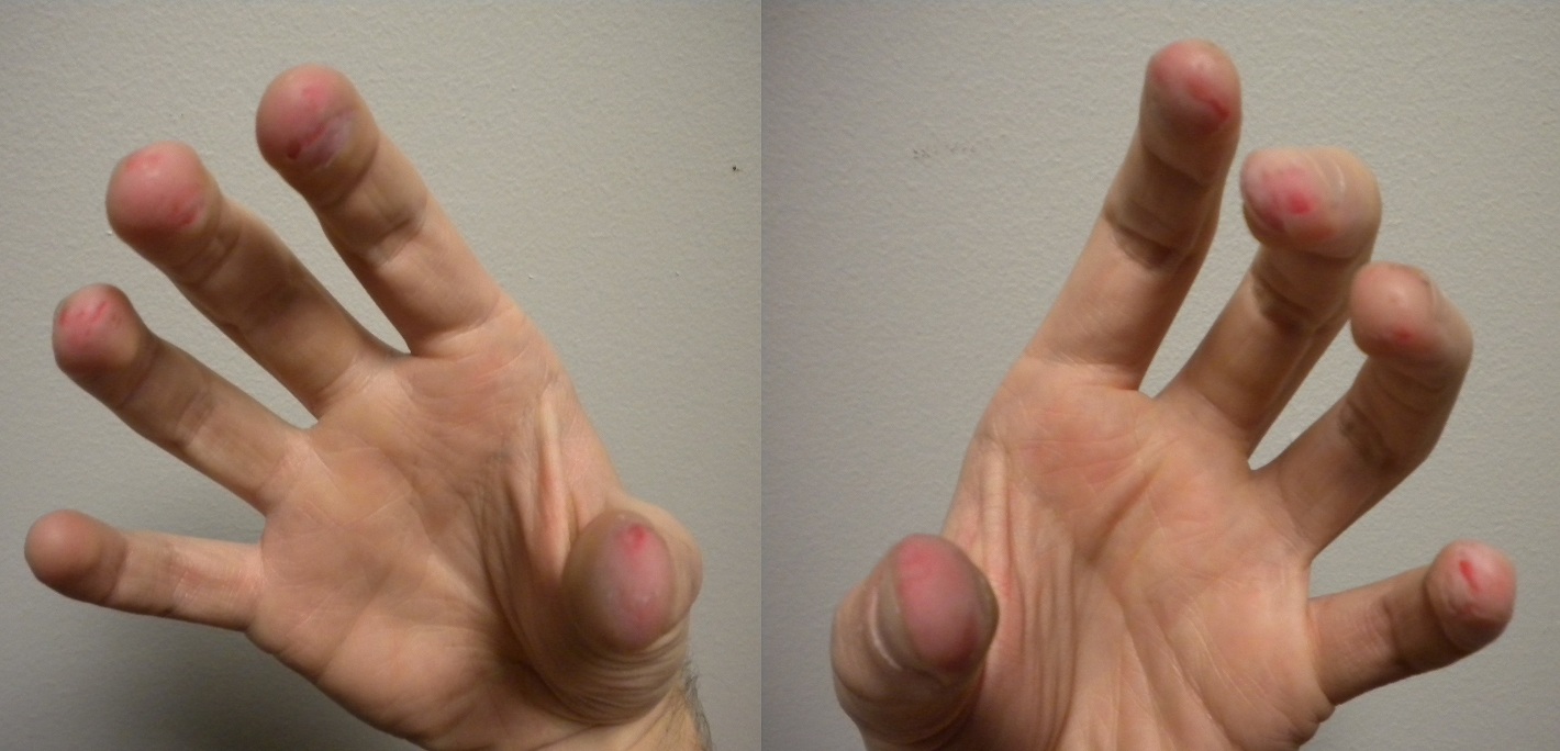 Fingers-dermatillomania