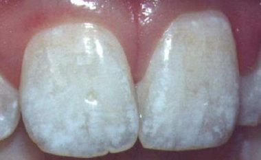 Nëse keni pika të bardha në dhëmbë, menjëherë shkoni te doktori!