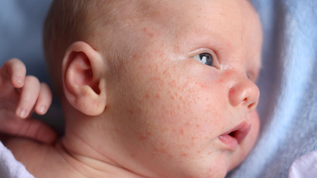 baby-eczema-rash-face