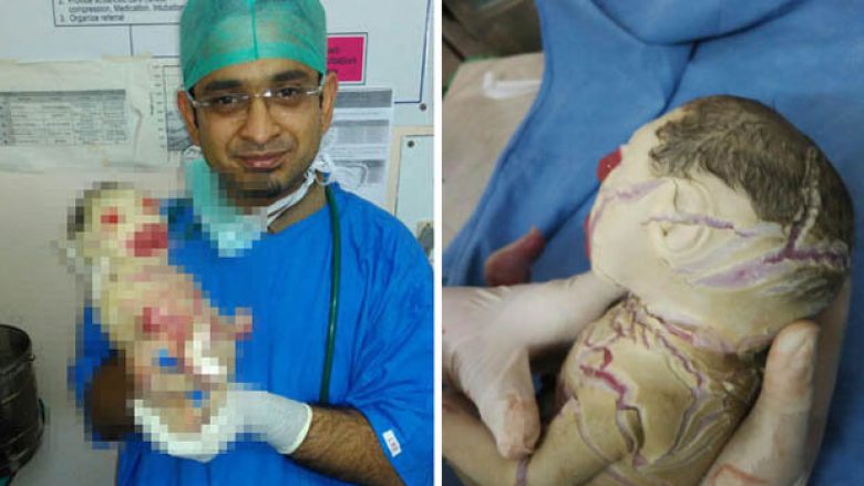 Fëmija i lindur pa lëkurë habit ekspertët mjekësorë! (Foto,+18)