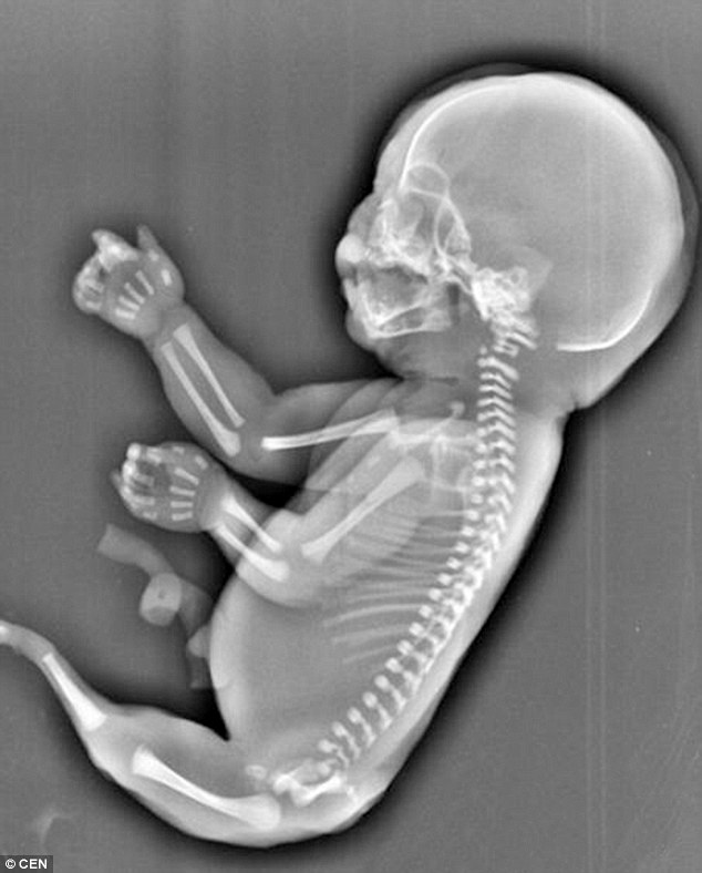 Abortohet bebja sirene qe ne vend te kembeve kishte nje bisht foto 2