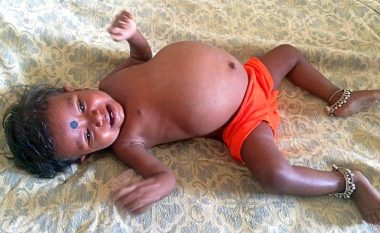 Bebes me bark të fryrë që nuk mund të hante, ia nxorën fetusin e binjakes së saj! (Foto/Video, +18)