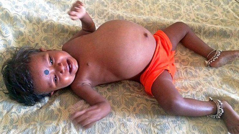 Bebes me bark të fryrë që nuk mund të hante, ia nxorën fetusin e binjakes së saj! (Foto/Video, +18)