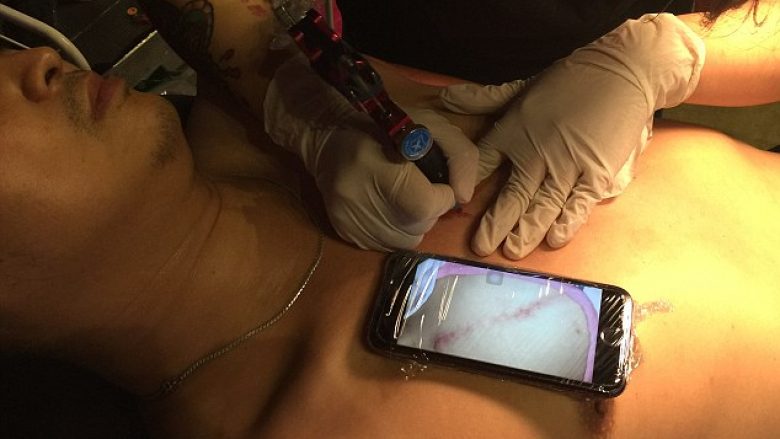 Bëri tatuazh për të mbështetur të birin, që i ka mbetur një ‘shenjë të shëmtuar’ pas operimit (Foto)